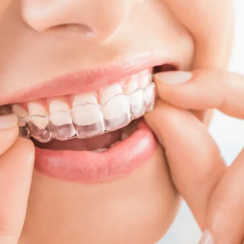 Invisalign