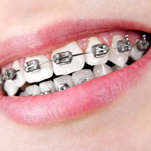 Teeth Braces