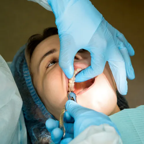 Wisdom Tooth Extraction