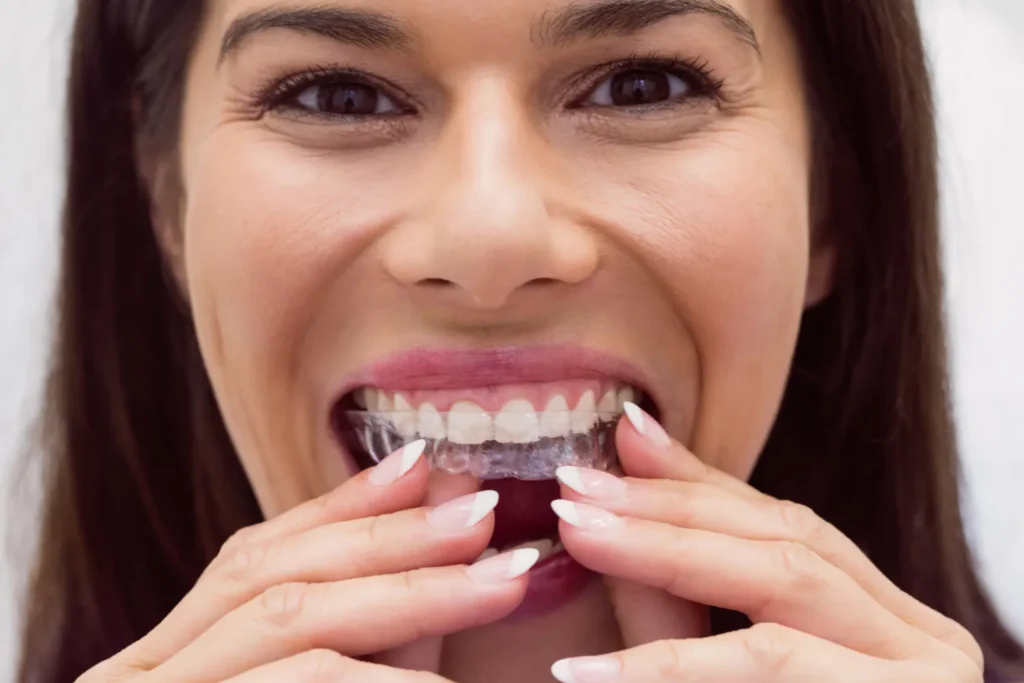 Braces And Invisalign Treatment in Koregaon Park