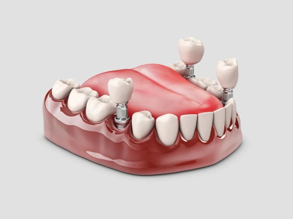 Dental implant clinic in Kalyani Nagar