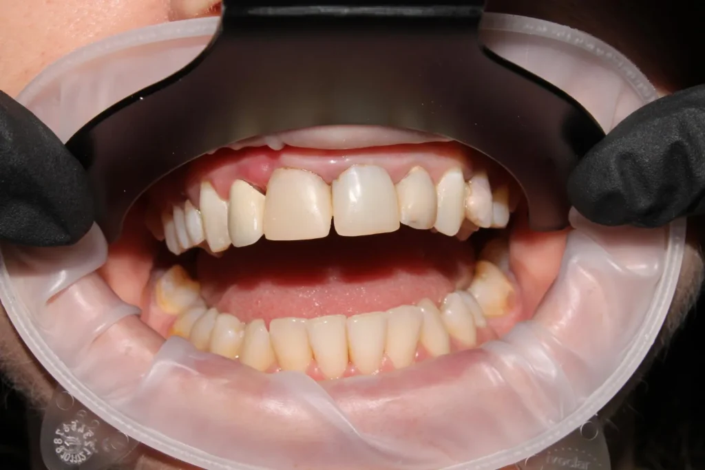 Regain your smile's beauty and function with expert prosthodontic care in Viman Nagar