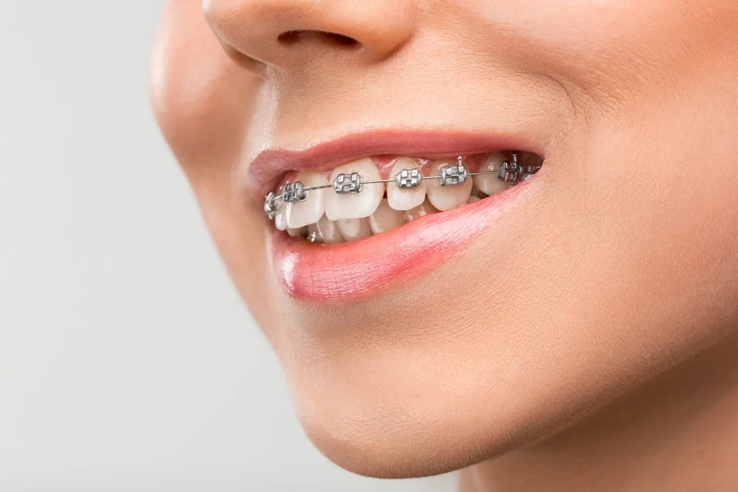 Teeth Braces in Pune