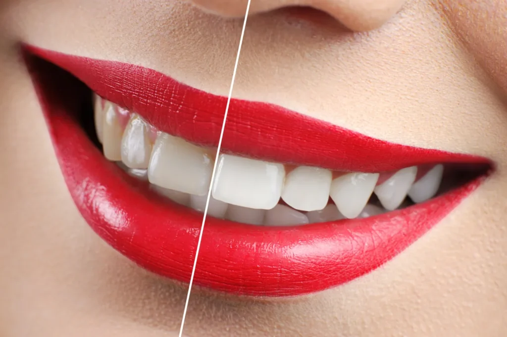 Teeth Whitening Service In Kalyani Nagar, Pune