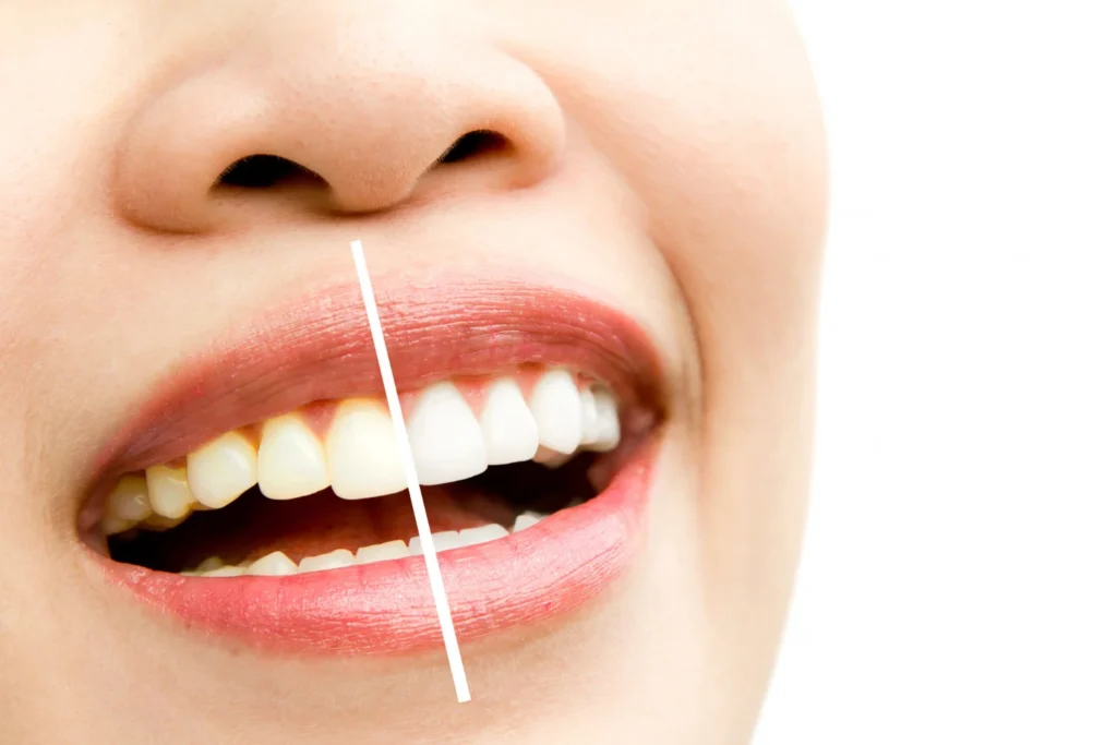Tooth Polishing Procedure