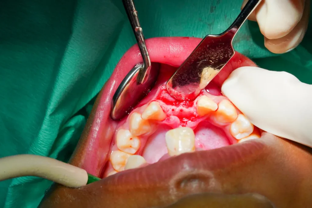 Factors Responsible for Bleeding After Tooth Extraction