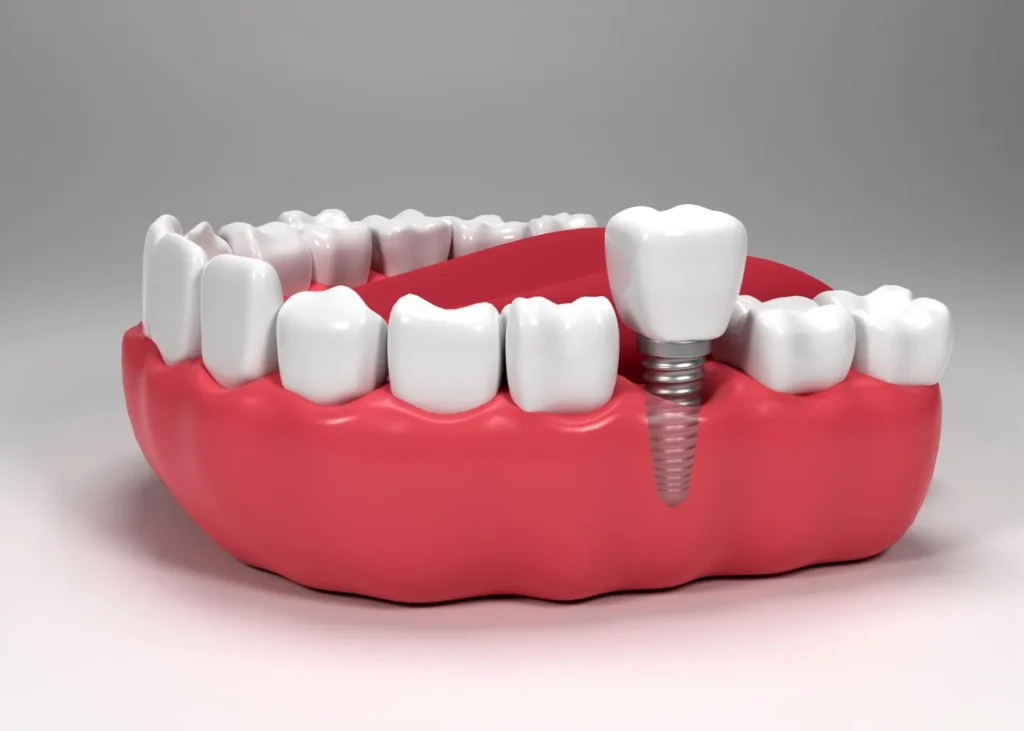 Dental Implants Kharadi
