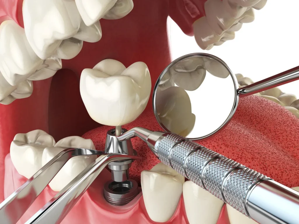 Dental Implants Vadgaon Sheri