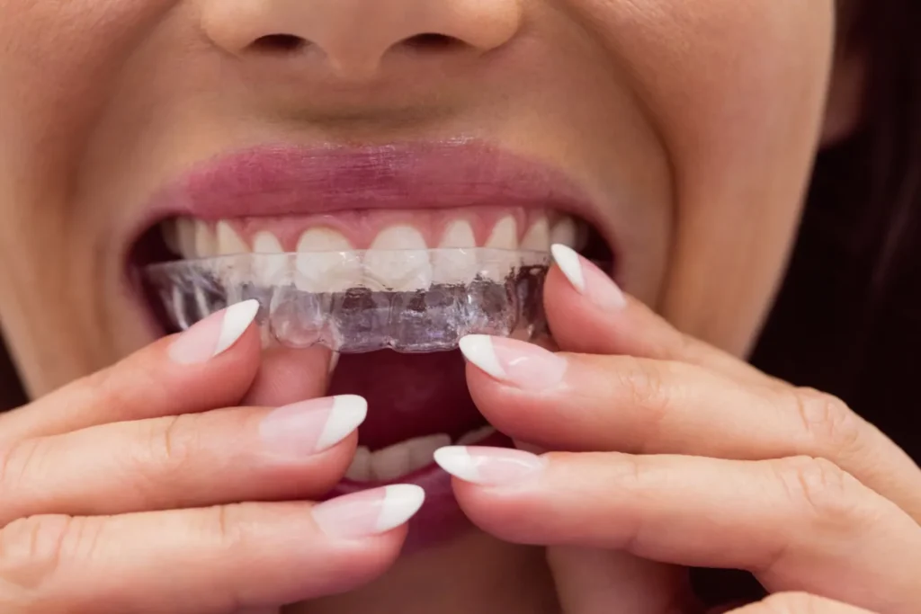 Invisalign Kharadi