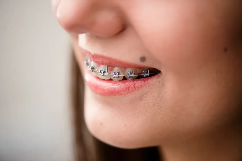 Teeth Braces Vishrantwadi
