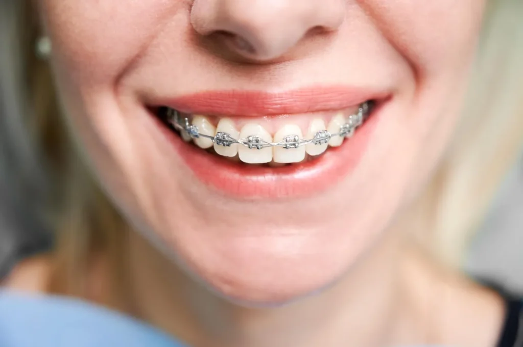 Comparing the Costs of Invisalign vs Regular Braces