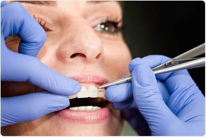 Dental Teeth Braces Treatment