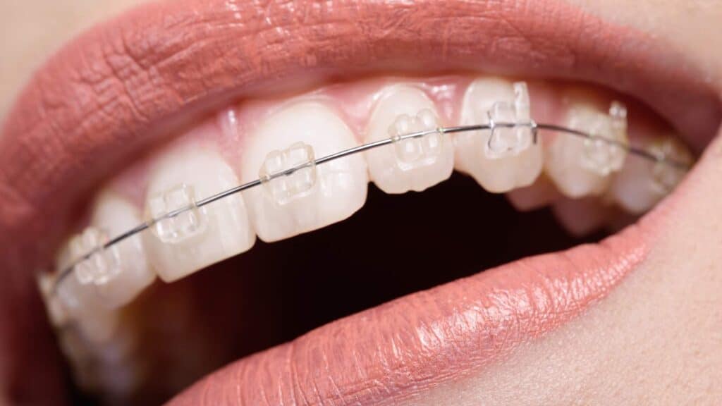Damon Self‑Ligating Braces