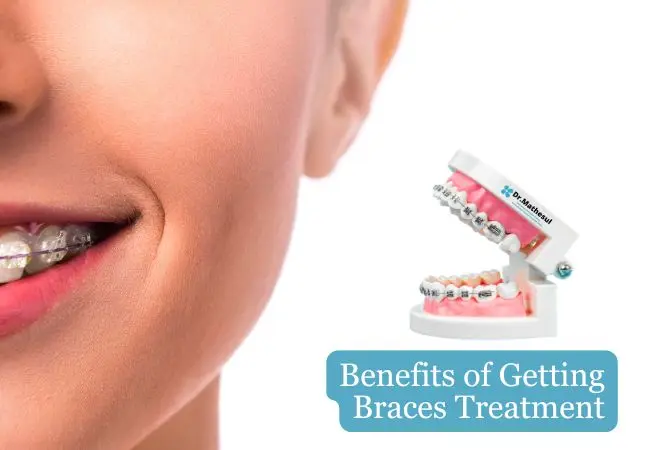 Benefits of Getting Braces Treatment